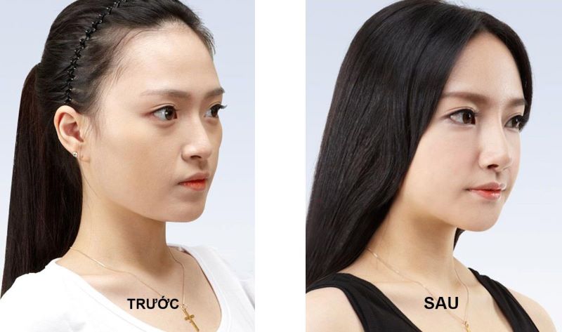 Nâng mũi là phẫu thuật thay đổi hình dáng, cấu trúc mũi để trông cân đối và đẹp hơn